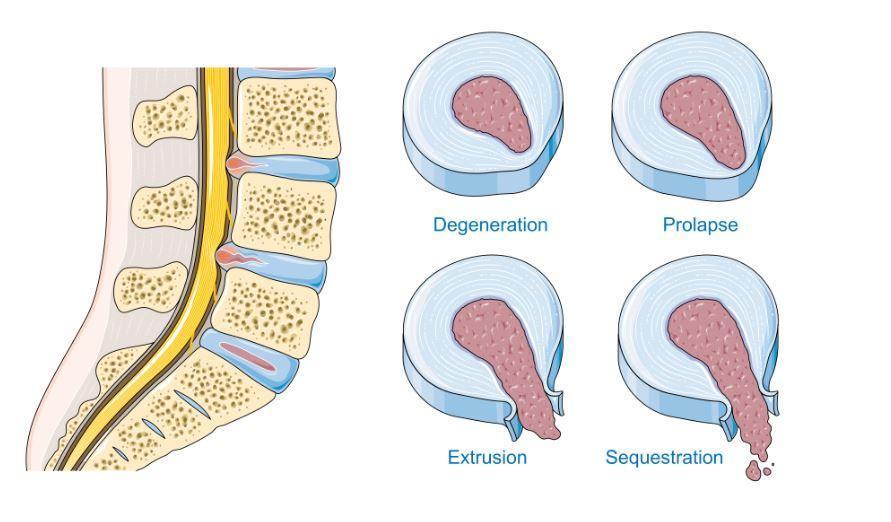 Herniated Disc: Can Physiotherapy Help Avoid Surgery?